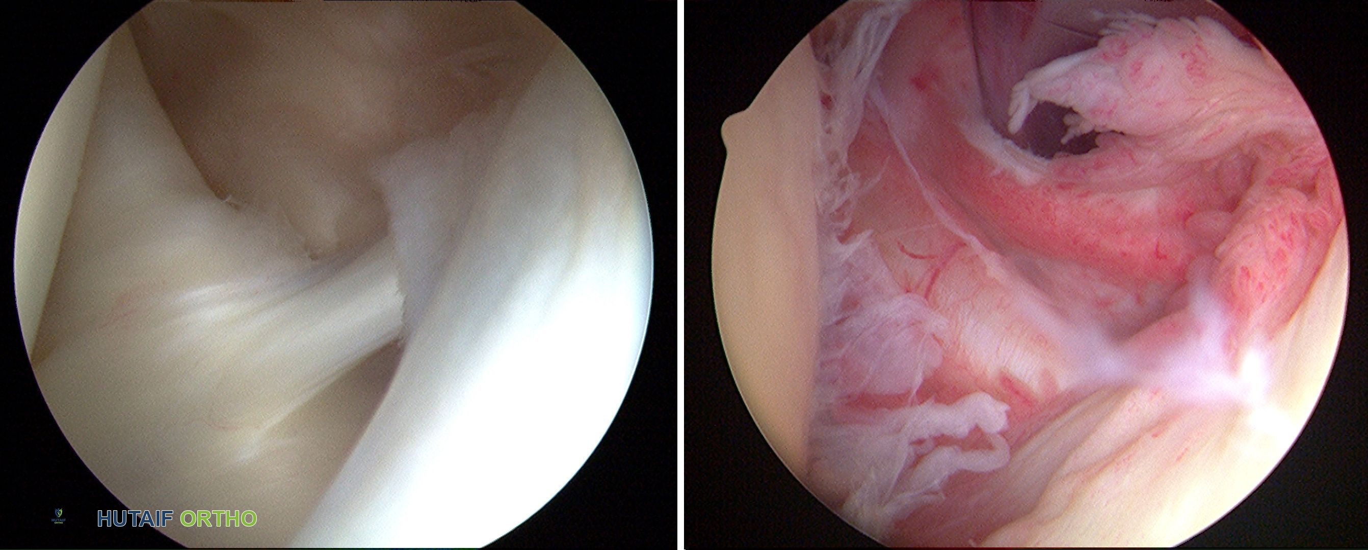 مقارنة بين محفظة الكتف الطبيعية والملتهبة